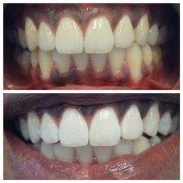 Pure white mobile teeth whitening