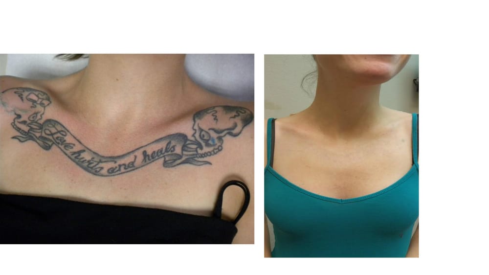 laguna laser hair removal u0026 aesthetics 12 photos u0026 30 reviews laguna laser hair removal u0026 aesthetics 12 photos u0026 30 reviews