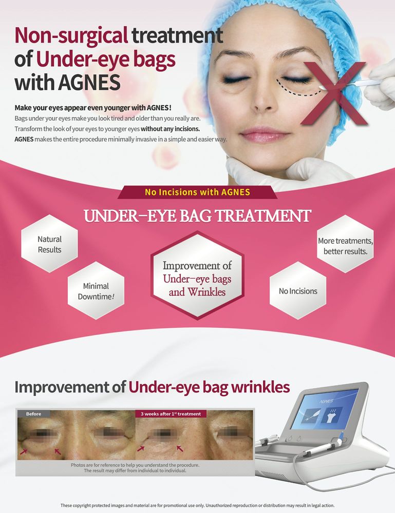 Agnes is a radiofrequency microneedling device for non surgical under eye bag treatment with