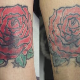 tattoo removal canada closed 18 photos tattoo removal 2300 tattoo removal canada closed 18 photos tattoo removal 2300