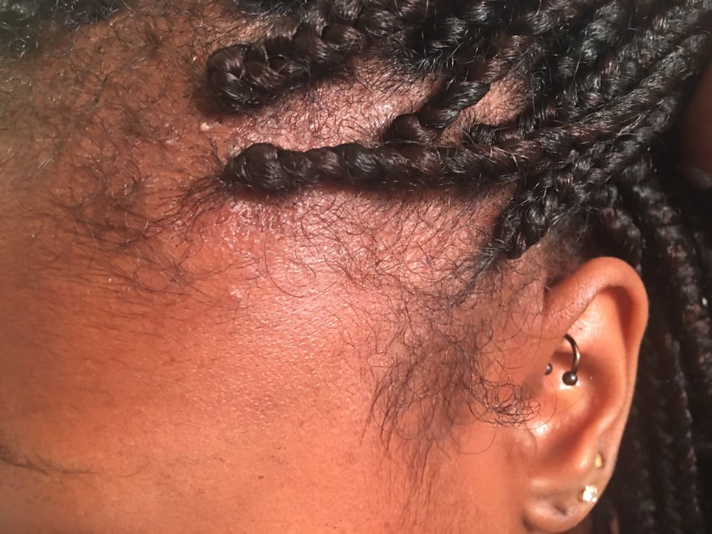 White Bumps Around Braided Hair | braids too tight bumps bumps from tight braids hairstyle White Bumps Around Braided Hair | braids too tight bumps bumps from tight braids hairstyle