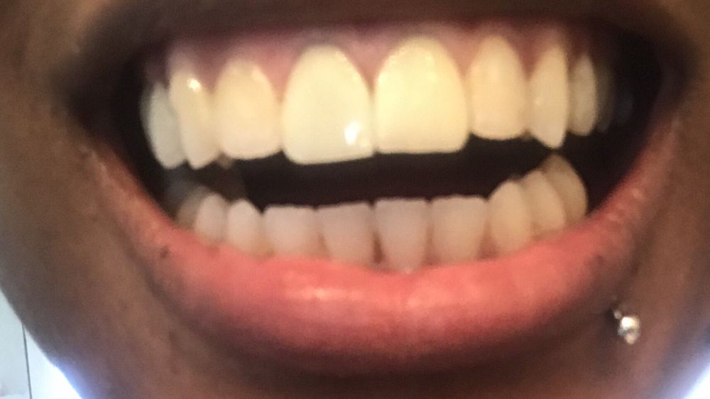 Two Front Teeth Veneers Before And After TeethWalls