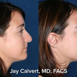 jay calvert md facs cosmetic surgeons 1401 avocado jay calvert md