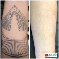 Photo Of Medermis Tattoo Removal Austin Tx United States After Laser Photo Of Medermis Tattoo Removal Austin Tx United States After Laser