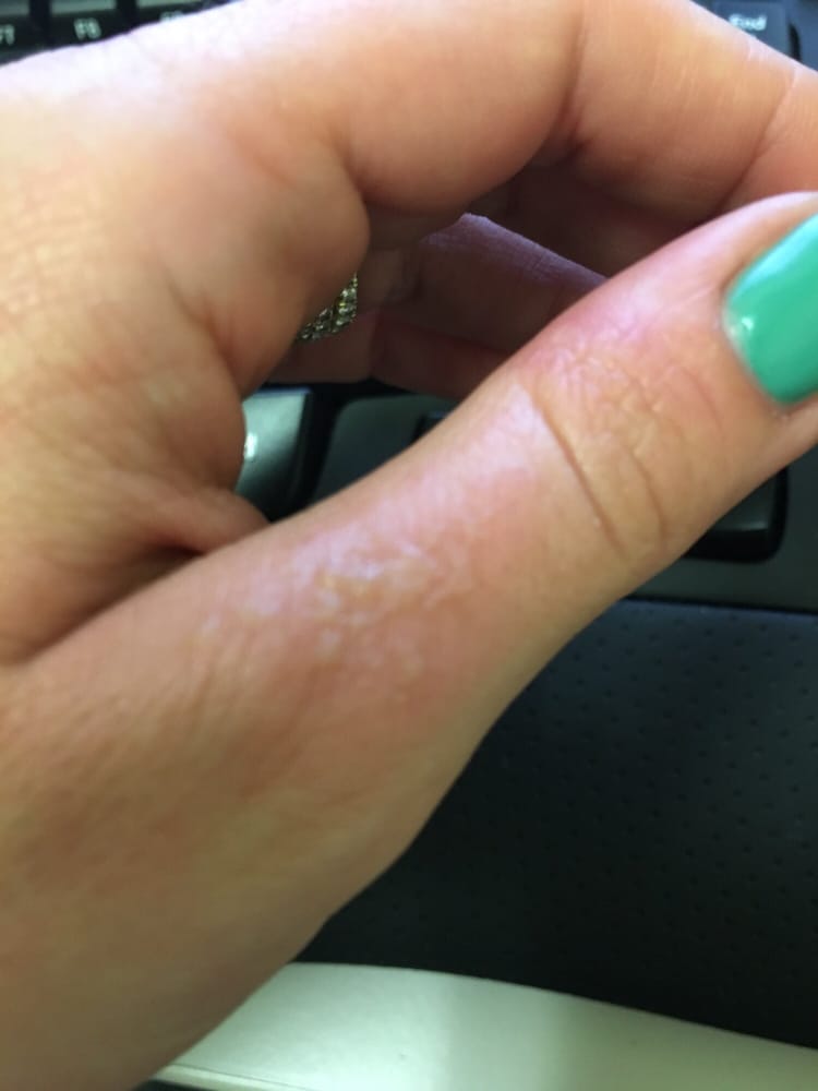 Why Do Gel Manicures Burn Pinpoint Properties Why Do Gel Manicures Burn