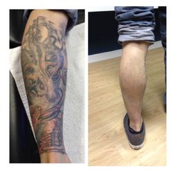disappearing inc 16 photos u0026 10 reviews tattoo removal 25 disappearing inc 16 photos u0026 10 reviews tattoo removal 25