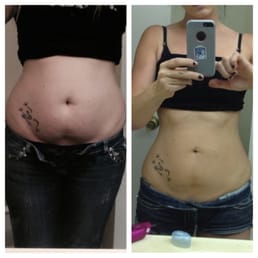 Image Result For Phentermine Before Andafter 258s Phentermine Before Andafter