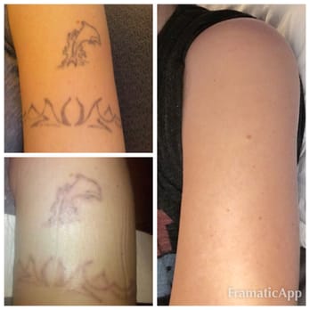 atlantic laser tattoo removal tattoo removal 277 n lynnhaven atlantic laser tattoo removal tattoo removal 277 n lynnhaven