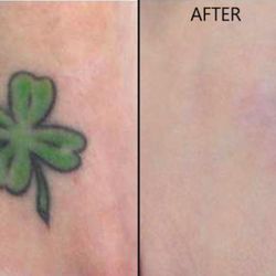 premium tattoo removal tattoo removal 6 171 station rd premium tattoo removal tattoo removal 6 171 station rd